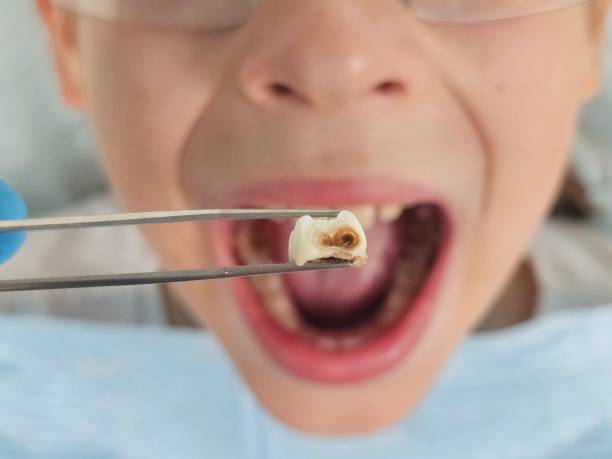 Best Emergency Root Canal Treatment in Mont Belvieu, TX